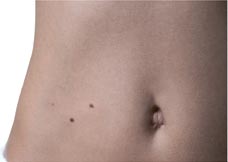 Mole removal price