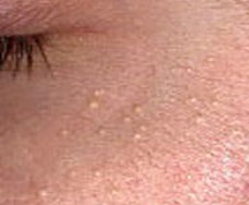 milia under eye