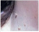 Skin conditions